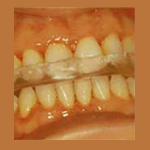 Placas de relajación neuromuscular