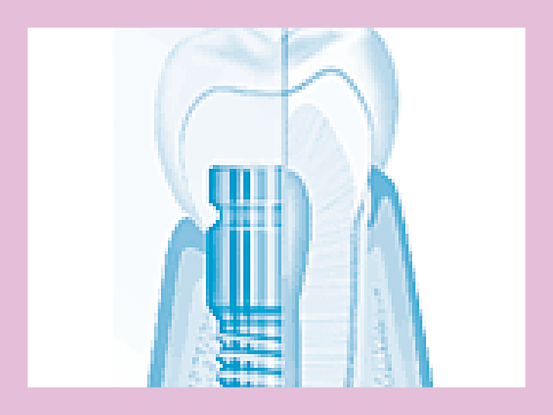 implantes dentales
