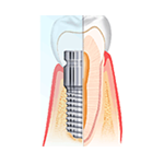 Implantes Dentales