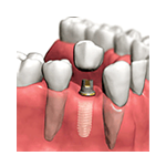 Implantes Dentales