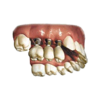 Implantes Dentales