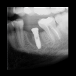 Implantes Dentales