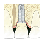 Implantes Dentales