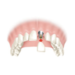 Implantes Dentales