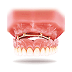Implantes Dentales